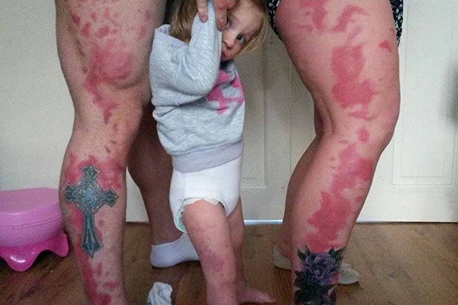 Des-parents-se-font-tatouer-des-taches-sur-les-jambes-pour-imiter-les-taches-de-naissance-de-leur-fille
